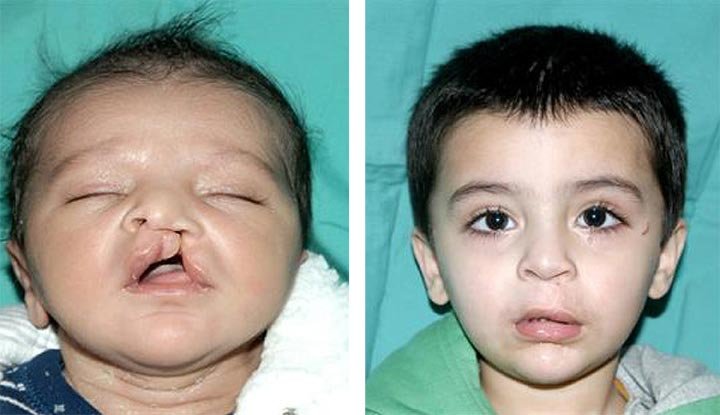 Cleft Lip and Palate Surgery