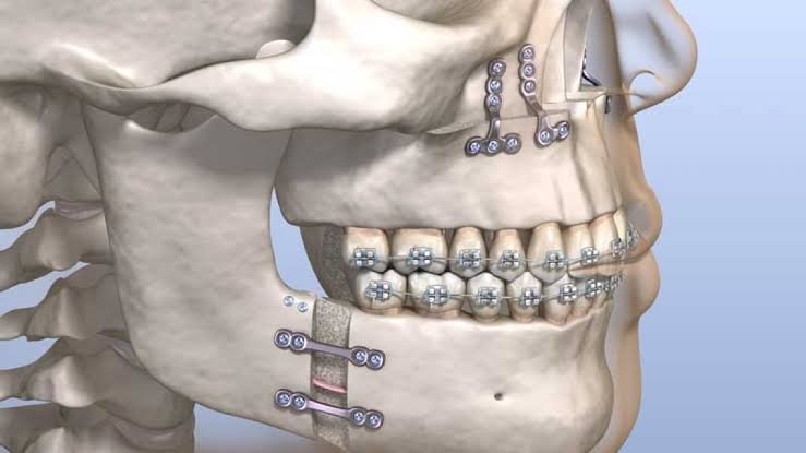 Orthognathic Jaw Surgery