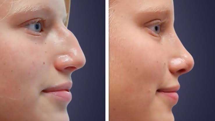 Rhinoplasty Surgery