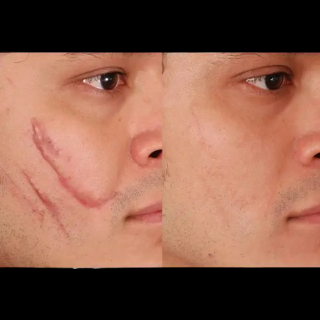 Scar Revision